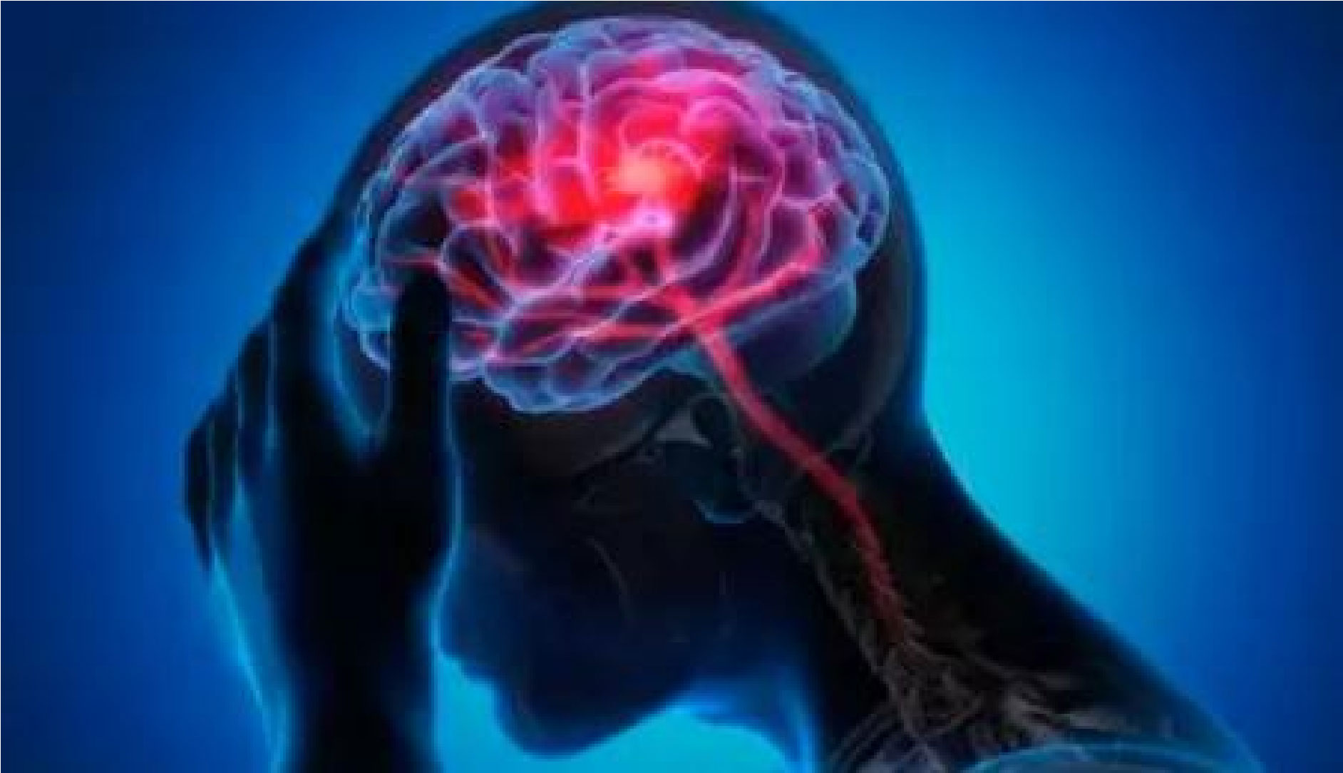 স্ট্রোক হলো মস্তিষ্কে