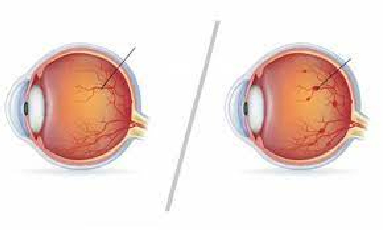 বিশ্বব্যাপী অন্ধত্বের প্রধান কারণ