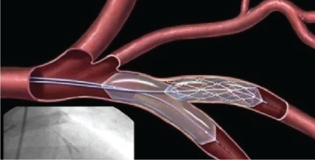 হার্টের রিংয়ের নতুন মূল্য